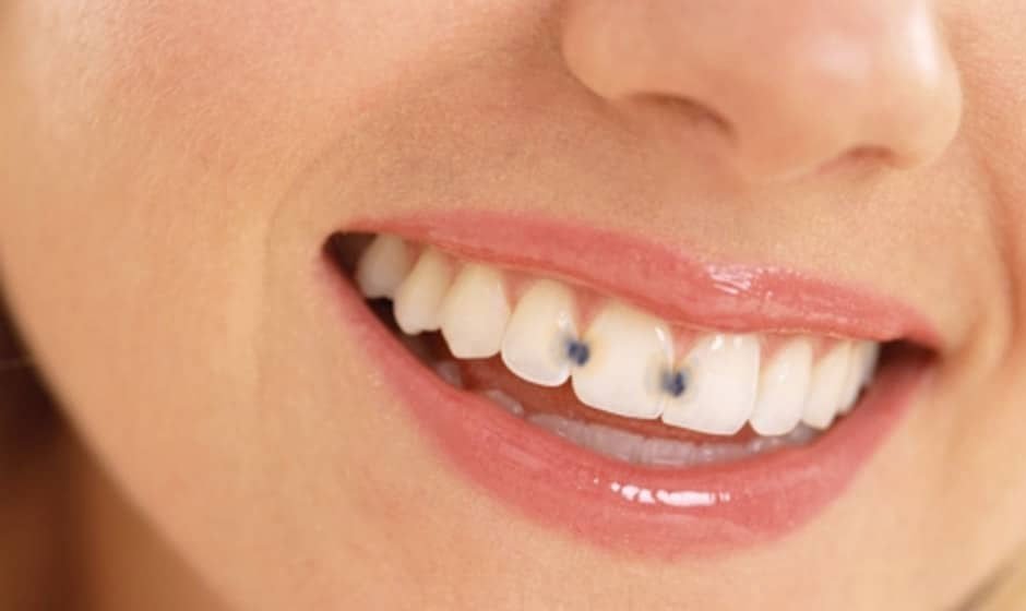 cavity between teeth
